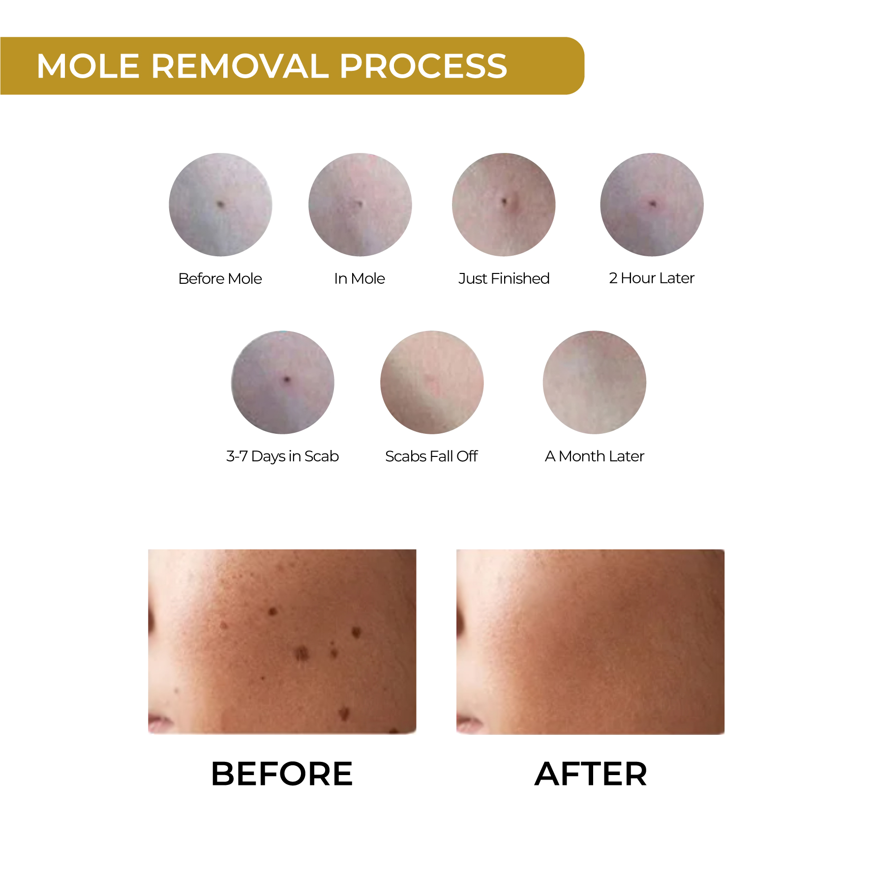 淘宝痣激光笔那种好用激光去疣的仪器